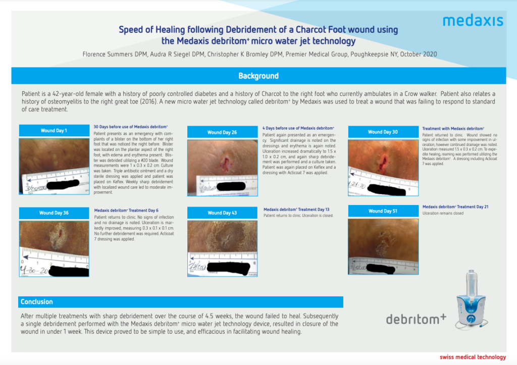 Micro water jet debridement system of Acute Chronic Wounds